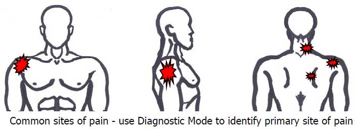 Common sites of pain - use Diagnostic Mode to identify primary site of pain